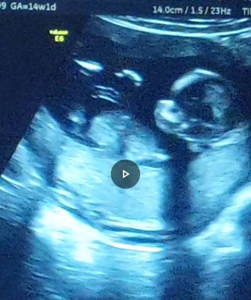 Bild zu Erstes Gesichtsprofil unserer Prinzessin ❤️ - Forum für April - Mamis