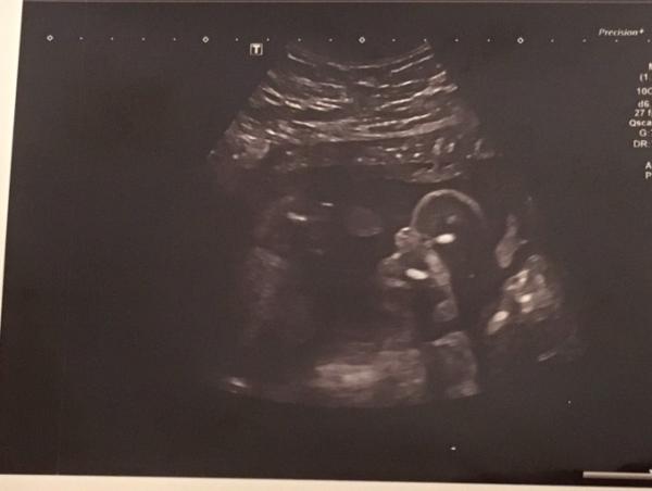 Bild zu Ultraschallbild - Forum für April - Mamis