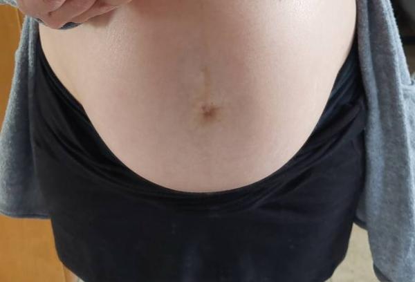 Bild zu Ist das ein nabelbruch? - Forum für April - Mamis
