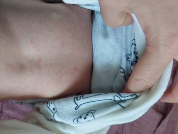Bild zu Ausschlag Brust - was tun? Hebamme und Kinderarzt heute nicht erreichbar - Forum für April - Mamis