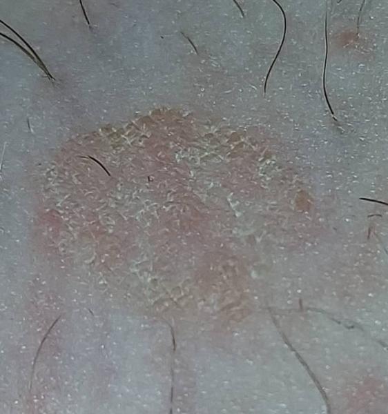 Bild zu Decoderm (Kortisonsalbe) benutzen??? - Forum für April - Mamis