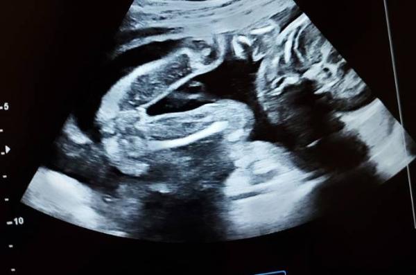 Bild zu Geschlechtserkennungs Experten? - Forum für April - Mamis