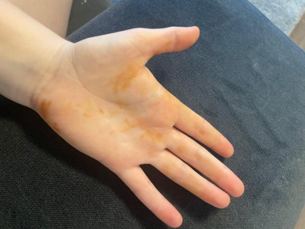 Bild zu Braune Flecken? - Forum für April - Mamis