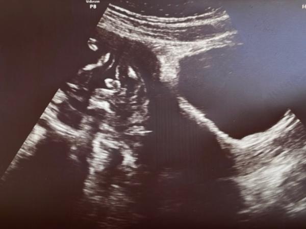 Bild zu Ultraschallbild - welches Geschlecht? :) - Forum für April - Mamis