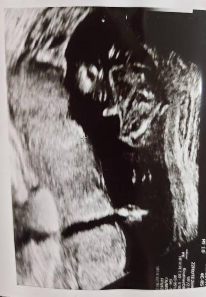 Bild zu Geschlecht raten - Ultraschall 19+1 - Forum für April - Mamis