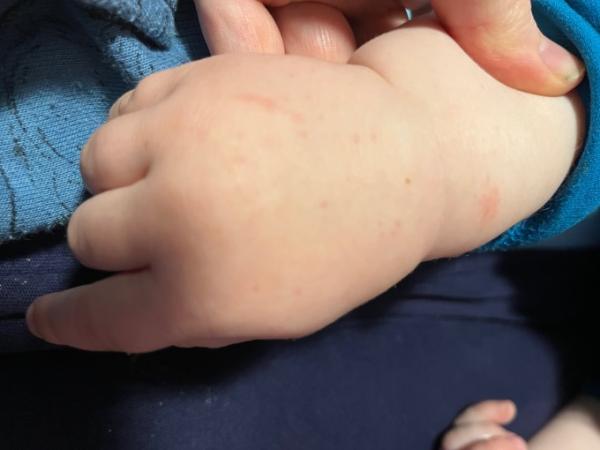 Bild zu Ausschlag Handrücken? - Forum für April - Mamis