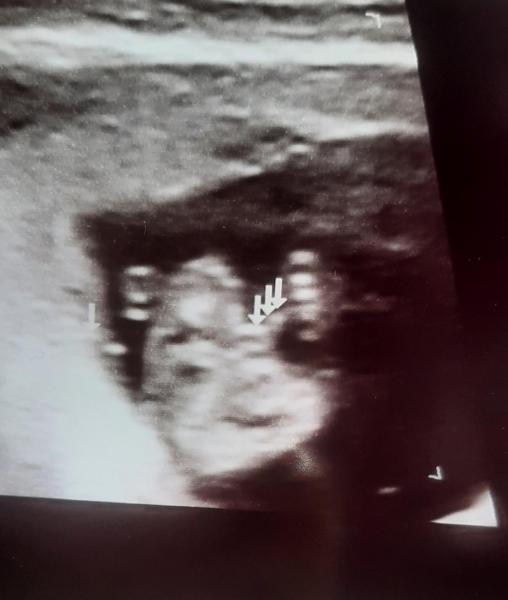 Bild zu Rätselraten Ultraschall ssw 13+2 - Forum für April - Mamis