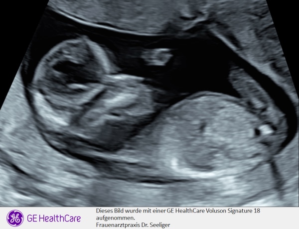Bild zu 1 Trimester größer Ultraschall und Nipttest - Forum für April - Mamis