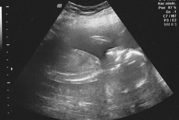 Bild zu Hatte heute den 2. großen Ultraschall - Forum für Mai - Mamis