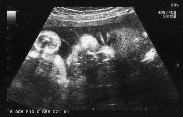 Bild zu 3.Ultraschall - Forum für Mai - Mamis
