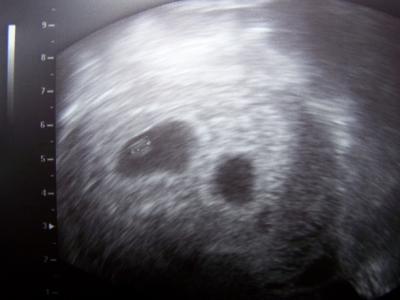 Bild zu @Kugelfisch und alle anderen, die es interessiert: US Bilder Zwillis - Forum für Mai - Mamis