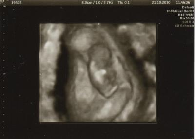 Bild zu Bisher 5 Tage aus dem KH und ein 4D Ultraschallbild :-) - Forum für Mai - Mamis