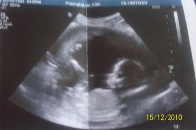 Bild zu FW UNtersuchung und endlich richtige aussage wegen der Chronizottenbiopsie! - Forum für Mai - Mamis
