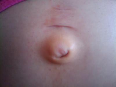 Bild zu Nabelbruch ? Ich weiss es nicht - Forum für Mai - Mamis