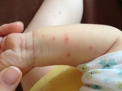 Bild zu Pickel - Forum für Mai - Mamis