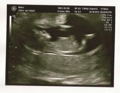 Bild zu Nackenfaltenmessung - Forum für Mai - Mamis