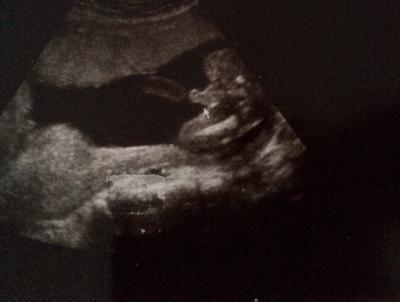 Bild zu Ultraschall Foto - Forum für Mai - Mamis