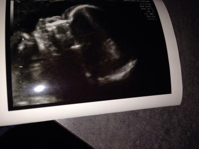 Bild zu Hier noch ein Bilchen vom Kopf;-) - Forum für Mai - Mamis