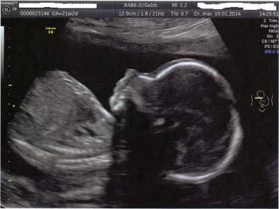 Bild zu Feindiagnostik gehabt und Bild - Forum für Mai - Mamis