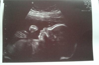 Bild zu White Spot ja oder nein?! - Forum für Mai - Mamis