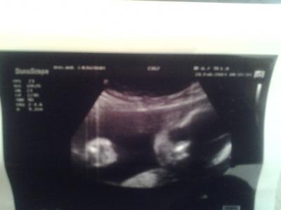 Bild zu eisenmangel troz tableten und tropfen zu niedrig - Forum für Mai - Mamis