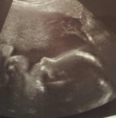 Bild zu gestern 3D-Ultraschall :) - Forum für Mai - Mamis