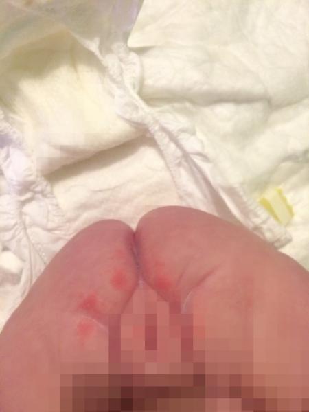Bild zu Roter Babypo und Verzweiflung - Forum für Mai - Mamis