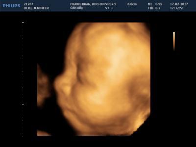 Bild zu 3D Ultraschall - Forum für Mai - Mamis