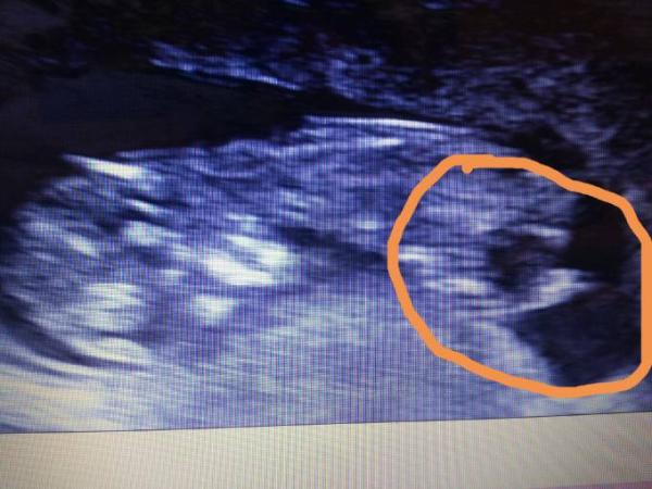 Bild zu Ultraschallbild deuten... brauche hilfe - Forum für Mai - Mamis