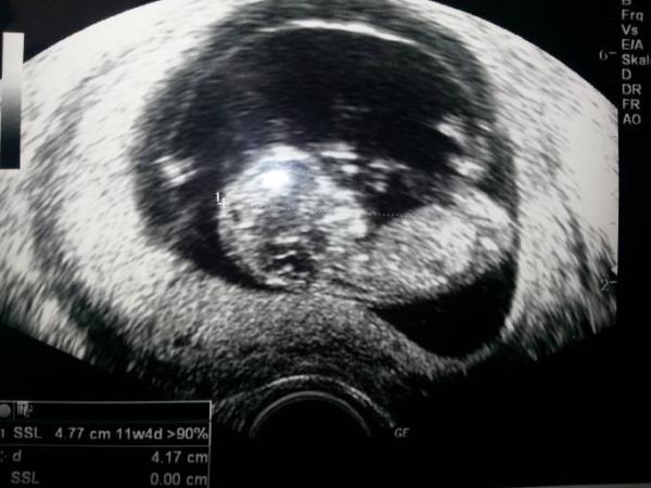 Bild zu wir sind noch dabei. Kontrolle gut verlaufen, sogar Tendenz erhalten - Forum für Mai - Mamis