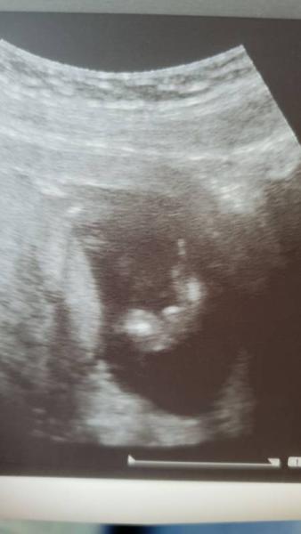 Bild zu Ultraschall Bild - Forum für Mai - Mamis