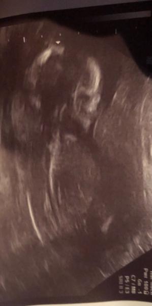 Bild zu 17ssw Geschlecht erkennen ? - Forum für Mai - Mamis