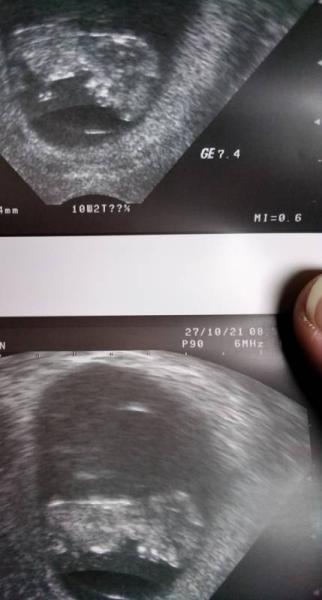 Bild zu Mein zweiter Ultraschallbild - Forum für Mai - Mamis