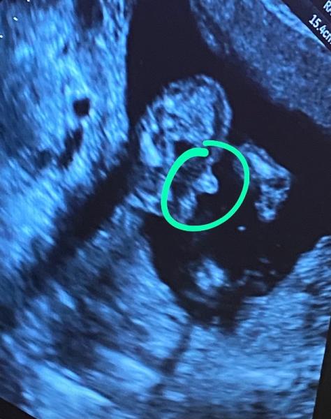 Bild zu Geschlecht Ultraschall 17 Woche - Forum für Mai - Mamis