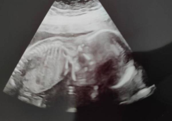 Bild zu 2. Screening... Muss zur Feindiagnostik - Forum für Mai - Mamis