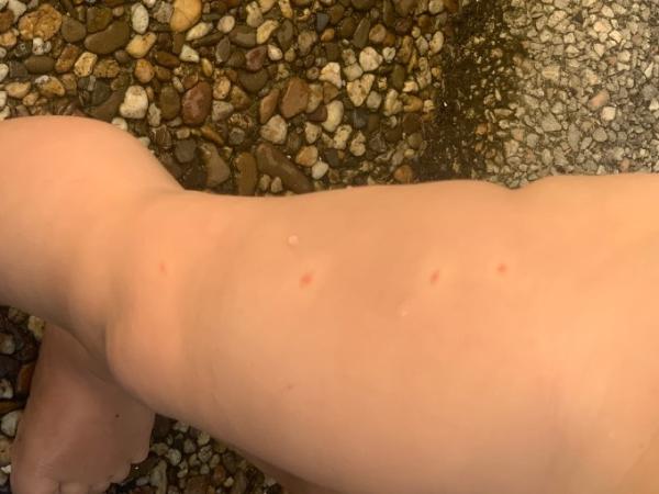 Bild zu Rote Flecken? Hilfe! - Forum für Mai - Mamis