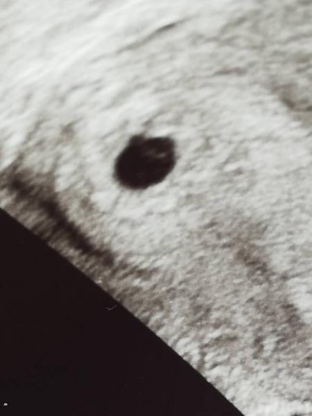 Bild zu Embryo, Dottersack oder nur ein Schatten? - Forum für Mai - Mamis