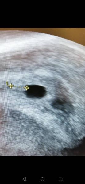 Bild zu Aktuelles Ultraschallbild - Forum für Mai - Mamis