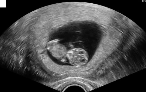 Bild zu Neuer Ultraschall Termin, das Baby bewegt sich .. - Forum für Mai - Mamis