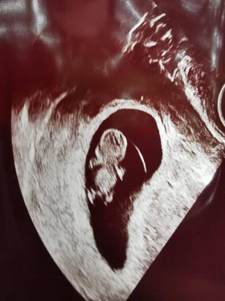 Bild zu Ultraschall Bild 8+3 - Forum für Mai - Mamis