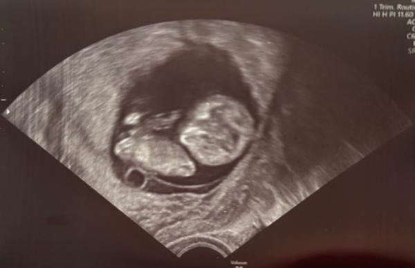 Bild zu Ultraschallbild Erklärung - Forum für Mai - Mamis
