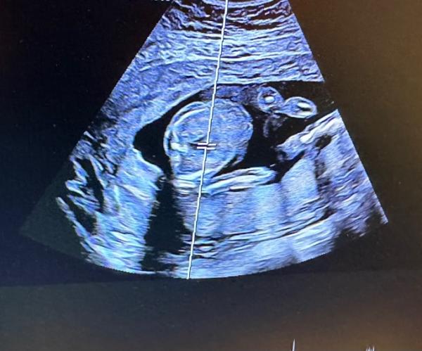 Bild zu Geschlecht 18ssw - Forum für Mai - Mamis