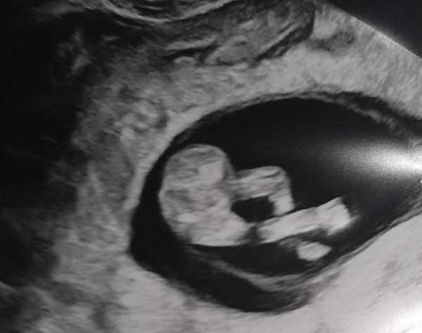 Bild zu Update Ultraschall ☺️ - Forum für Mai - Mamis