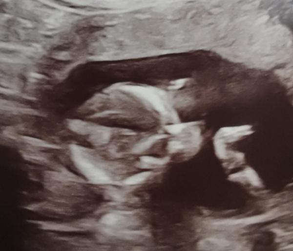 Bild zu Update Ultraschall - Forum für Mai - Mamis