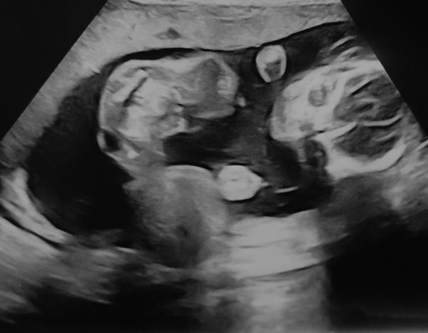 Bild zu Dickbauchdienstag verpasst - dann wird es halt ein Murmelmittwoch 🤰🏼😁 - Forum für Mai - Mamis