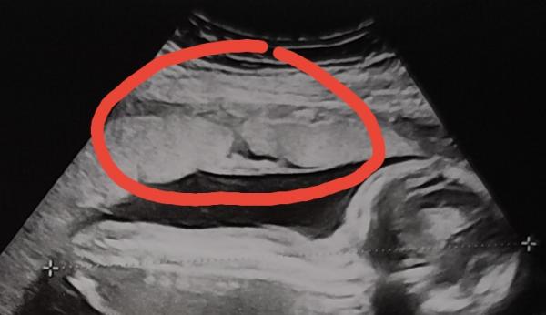 Bild zu nicht durchgängige Plazentastruktur - Forum für Mai - Mamis