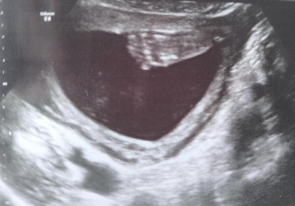 Bild zu 2. großer Ultraschall - Forum für Mai - Mamis