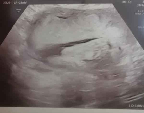 Bild zu Update Verlauf Schwangerschaft - Forum für Mai - Mamis