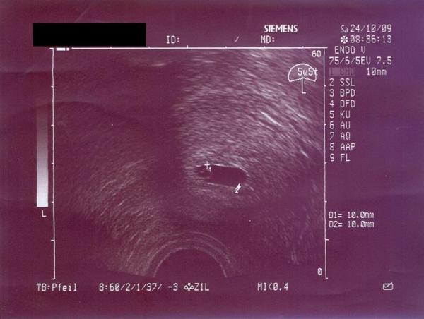Bild zu Ultraschallbild - Forum für Juni - Mamis