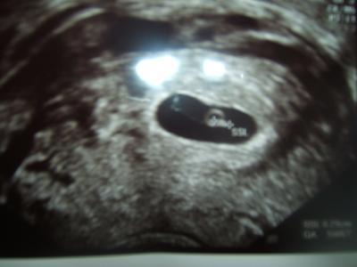 Bild zu ultraschallbilder von heute:=) - Forum für Juni - Mamis
